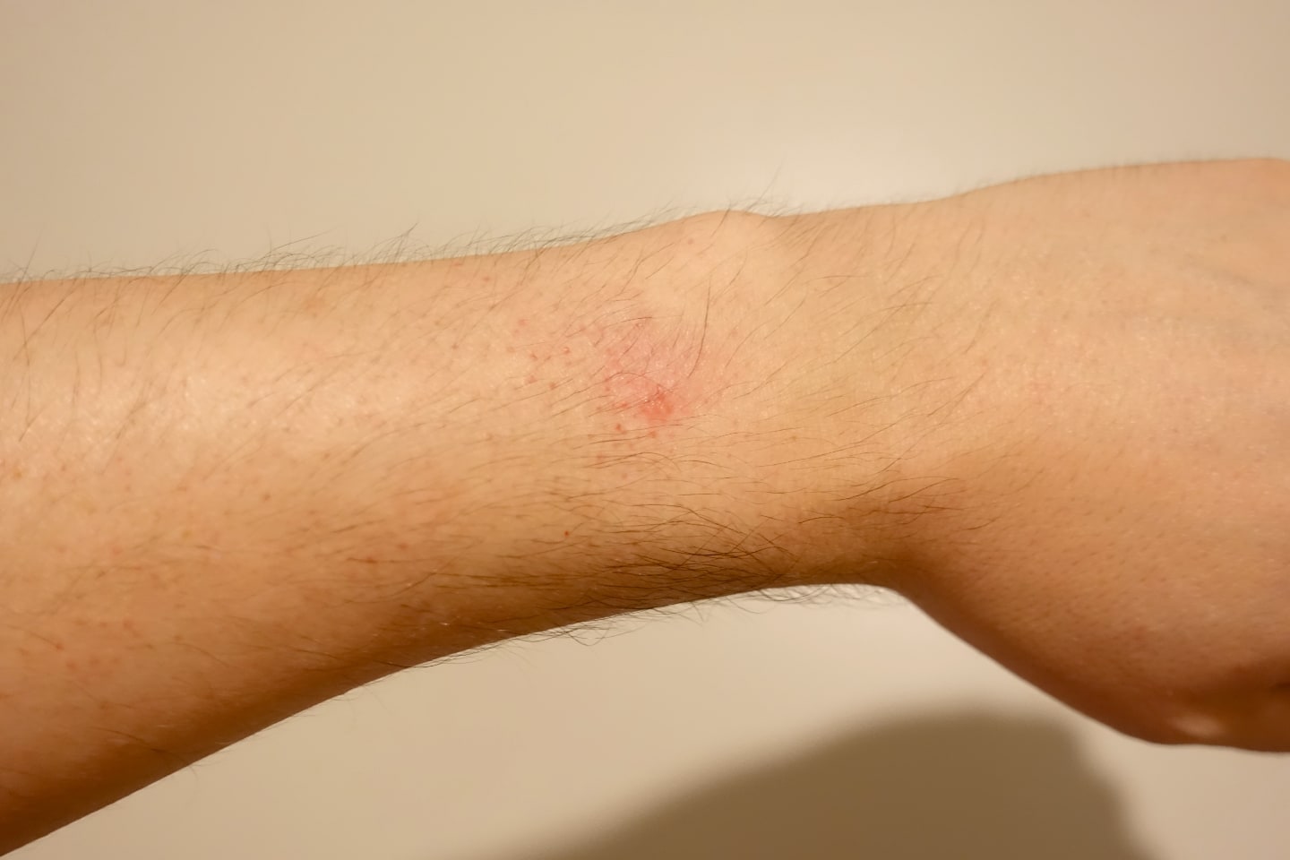 Detalhe de pequena queimadura no pulso, na região onde a caixa do Apple Watch entra em contato com a pele.